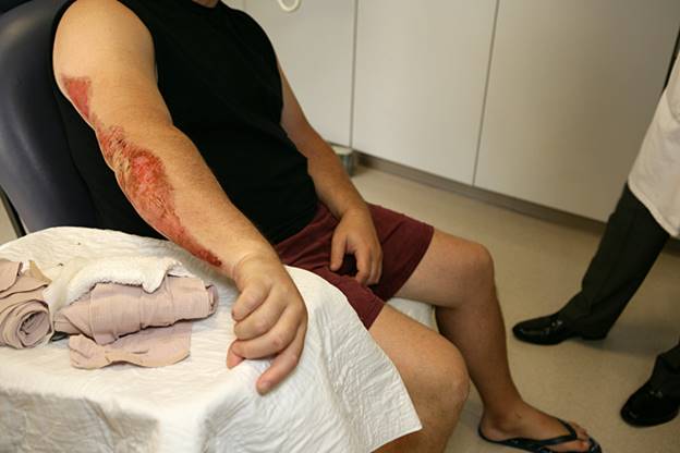 A person sitting on a table with a cut on his arm
AI-generated content may be incorrect.